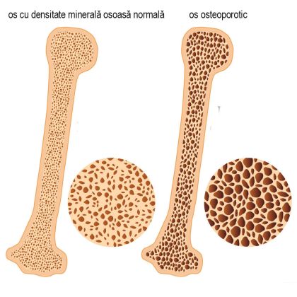 Osteoporoza